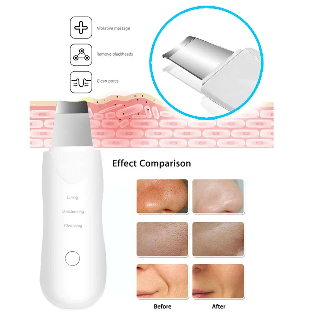Professional Ultrasonic Skin Scrubber & Peeler